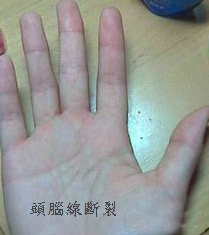 头脑线断裂