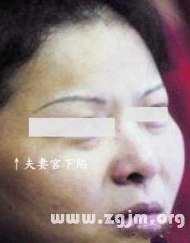 夫妻宫有痣