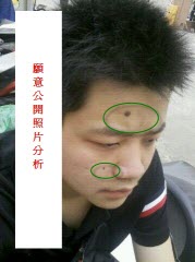 头发柔细耳朵肉多是非痣的照片分析